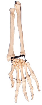 手掌骨带尺骨与桡骨模型A11125