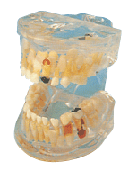 透明乳牙病理模型B10013 