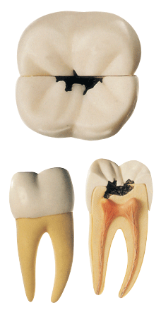 右测第一下磨牙蛀牙模型B10005/2 