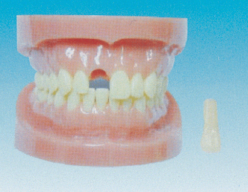 可卸式无根标准牙模型-上海佳悦公司:021-63283651 中国领先的医学教学模型设备制造厂家