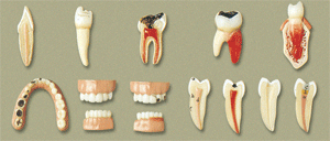 牙齿病变系列模型B10017-上海佳悦公司:021-63283651 中国领先的医学教学模型设备制造厂家
