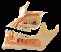 牙体病变模型B10016,牙模型-上海佳悦公司:021-63283651 中国领先的医学教学模型设备制造厂家