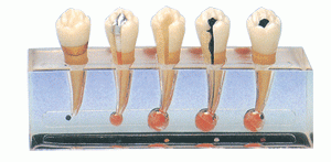 医疗教学假模型牙