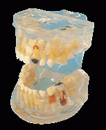 透明乳牙病理模型-上海佳悦公司:021-63283651中国领先的医学教学模型设备制造厂家