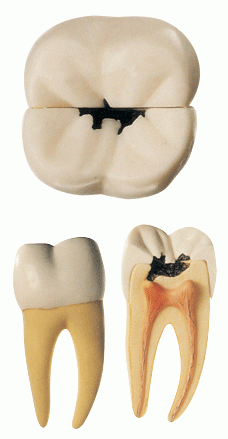 右测第一下磨牙蛀牙模型-是我公司自行研发生产热销的医学教学模型,欢迎各医院单位订购021-63283651
